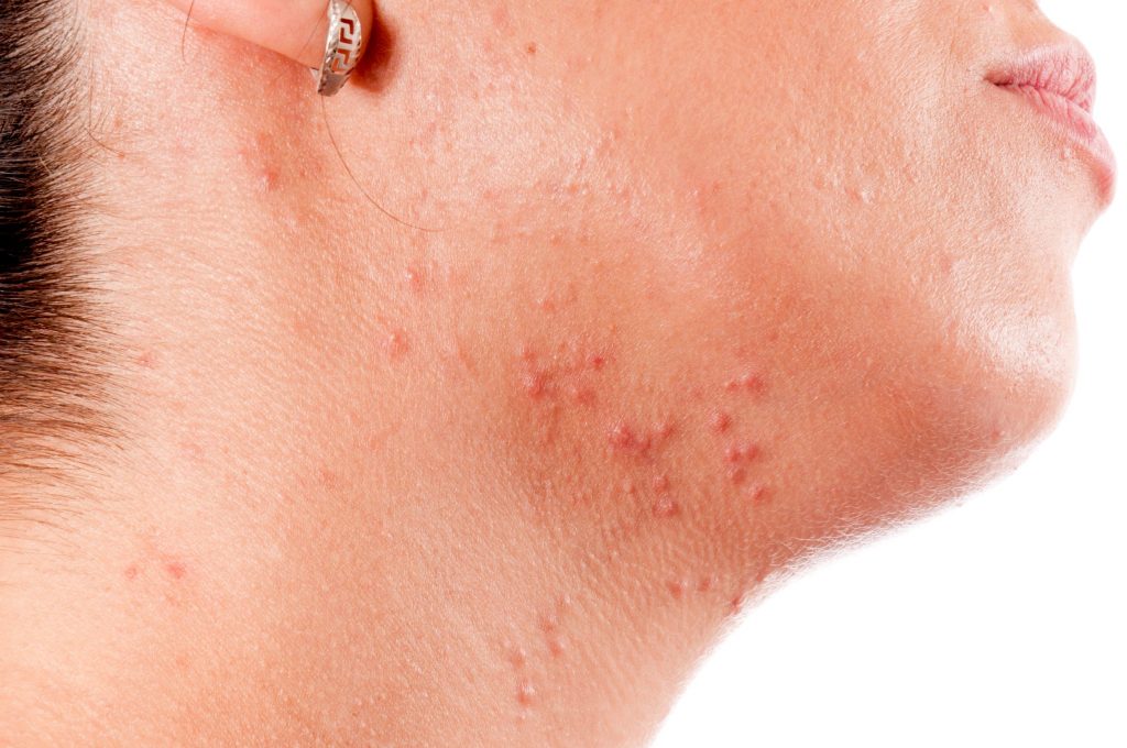 Acne vrouw kaaklijn.jpg