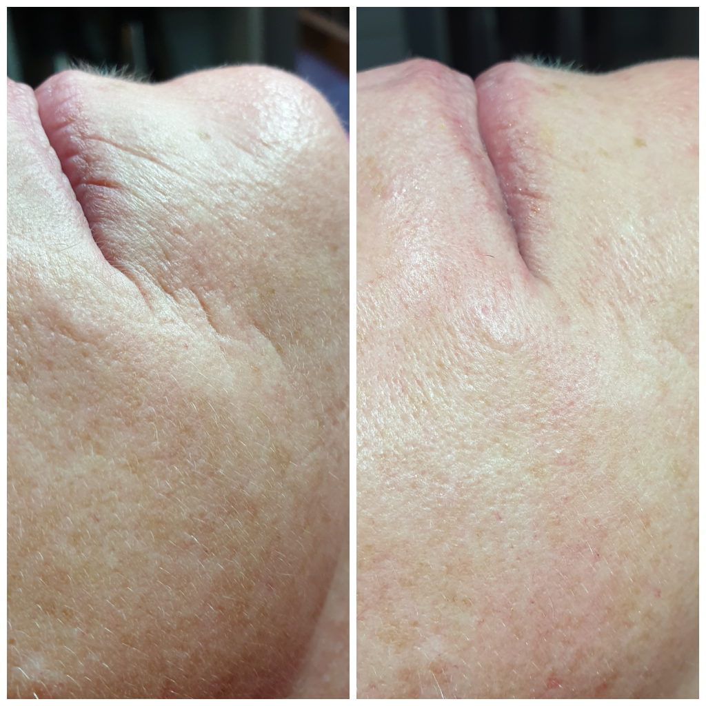 Anti-Rimpel gezichtsbehandeling voor en na foto LaSarel