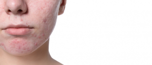 Acne basic behandeling lasarel