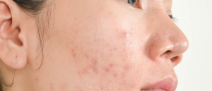 Acne behandeling